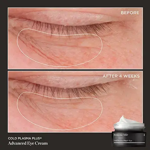 Image 1 - Image shows a close-up view of the area around the eyes, with the top half labeled “Before” showing visible fine lines and the bottom half labeled “After 4 Weeks” showing a smoother skin texture; a jar of Perricone MD Cold Plasma Plus+ Advanced Eye Cream is shown at the bottom right.
Image 2 - An image of a jar of Perricone MD Cold Plasma Plus+ Eye cream with text indicating that 100% showed a reduction in the appearance of crows feet, 94% showed improvement in skin elasticity, and 85% saw a reduction in the appearance of dark circles, with footnotes for study details.
Image 3 - A person is holding a jar of Perricone MD Cold Plasma Plus+ Eye cream, which has a white cream texture on top and features text about its ingredients: Vitamin C Ester, Omegas 3, 6 & 9, and Copper Tripeptide.
Image 4 - An image of a black jar of Perricone MD Cold Plasma Plus+ Eye cream with a swirled white cream visible inside, surrounded by five blue stars and a quote from a customer named Nana praising the products effectiveness. Image 5 - your cold plasma plus routine treat moisturiser and eye