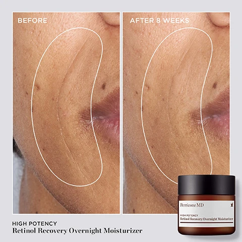 Image 2 - Image shows a split comparison of a persons face illustrating skin texture improvements after using a product for eight weeks, with the left side labeled before and the right side labeled after 8 weeks, and a jar of Perricone MD Retinol Recovery Overnight Moisturizer on the bottom.
Image 3 - A jar of Perricone MD High Potency Retinol Recovery Overnight Moisturizer is angled on a light brown surface, surrounded by a swirl of white cream; the image displays text stating 100% showed significant improvement in hydration, 91% saw reduced dullness by morning, and 83% showed a significant reduction in fine lines, wrinkles, uneven texture & tone.
Image 4 - Image shows a jar of Perricone MD High Potency Retinol Recovery Overnight Moisturizer with visible text highlighting features such as Triple Retinol Blend for advanced skin recovery, DMAE for intensive firming, and Vegetable Triglyceride Complex for powerful hydration.
Image 5 - A pair of hands holds a jar of Perricone MD High Potency Retinol Recovery Overnight Moisturizer, with five stars above and a review stating My skin looks plumper, firmer & smoother. —Amber D.
