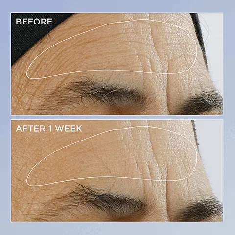 Image 1, before and after Image 2, Increases surface skin renewalin 3 days+Delivers firmer, collagen-rich skin*Perricone Mewal Sqple RetinPOTENCCLAToalMinimizes wrinkles & dullnessPOTENCY iple Retinol newal SerumxPerricone MDBGLLIGOHIGH BOLENCAbj Bo*In a clinical study of 38 waren. Image 2, BEFOREAFTER 1 WEEK Image 3, "It instantly absorbs into the skin leaving a healthy, noticeable glow, reducing fine lines & the appearance of pores."-Raze M.Perricone MPerricone MPerricone MDHIGH POTENCY Triple Retinol Renewal SerumHIGH POTENCY Triple Retinal Renewal Serum Image 4, Perricone MDXHIGH POTENCYTriple Retinol Renewal Serum83%said it smooths skin texture & reduces dullness*76%showed a reduction in fine linest &improvement inelasticity** & resiliency**96%said it feels gentle on skin*"In a consumer study of 102 women after 28 days. **In a clinical study of 37 women after 4 weeks after 8 weeks. Image 5, Perricone MDXHIGH POTENCYTriple Retinol Renewal Serum(RTRIPLE RETINOL BLEND gently acceleratesskin renewal(Q10)COENZYME Q10 visibly diminishes uneven tone & wrinklesBETA-CAROTENE minimizes the look of uneven texture & redness