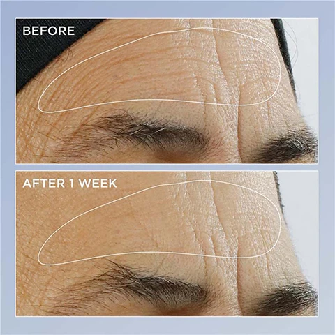 Image 1 - Image comparing forehead wrinkles before and after one week of treatment, with BEFORE in the top section and AFTER 1 WEEK in the bottom section.
Image 2 - Image showing a side-by-side comparison of an eye area; the top half labeled BEFORE displays more wrinkles and fine lines, while the bottom half labeled AFTER 4 WEEKS shows smoother skin with reduced wrinkles.
Image 3 - Image features two brown bottles of Perricone MD skincare products on a brown background, one labeled High Potency Triple Retinol Renewal Serum and the other High Potency Triple Retinol Eye Serum, with cream swatches beside each bottle and text highlighting benefits such as delivers firmer skin, minimizes wrinkles, diminishes crows feet, and minimizes under-eye darkness.
Image 4 - An image of two Perricone MD serum bottles on a marble surface, with five-star ratings and customer quotes about the products effectiveness. The visible text includes Raze Ms review: It instantly absorbs into the skin leaving a healthy, noticeable glow, reducing fine lines & the appearance of pores, and Heather Ss review: My eye area looks very smooth, supple & more youthful.